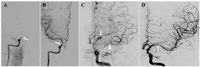 Endovascular Recanalization and Standard Medical Management for Symptomatic Non-acute Intracranial Artery Occlusion: Study Protocol for a Non-randomized, 24-Month, Multicenter Study
